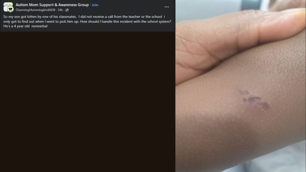 nonverbal child bitten at school