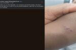 nonverbal child bitten at school